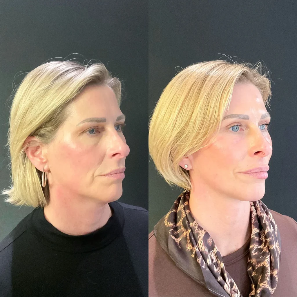 Before and after plastic surgery