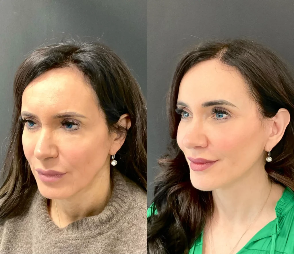 Before and after plastic surgery