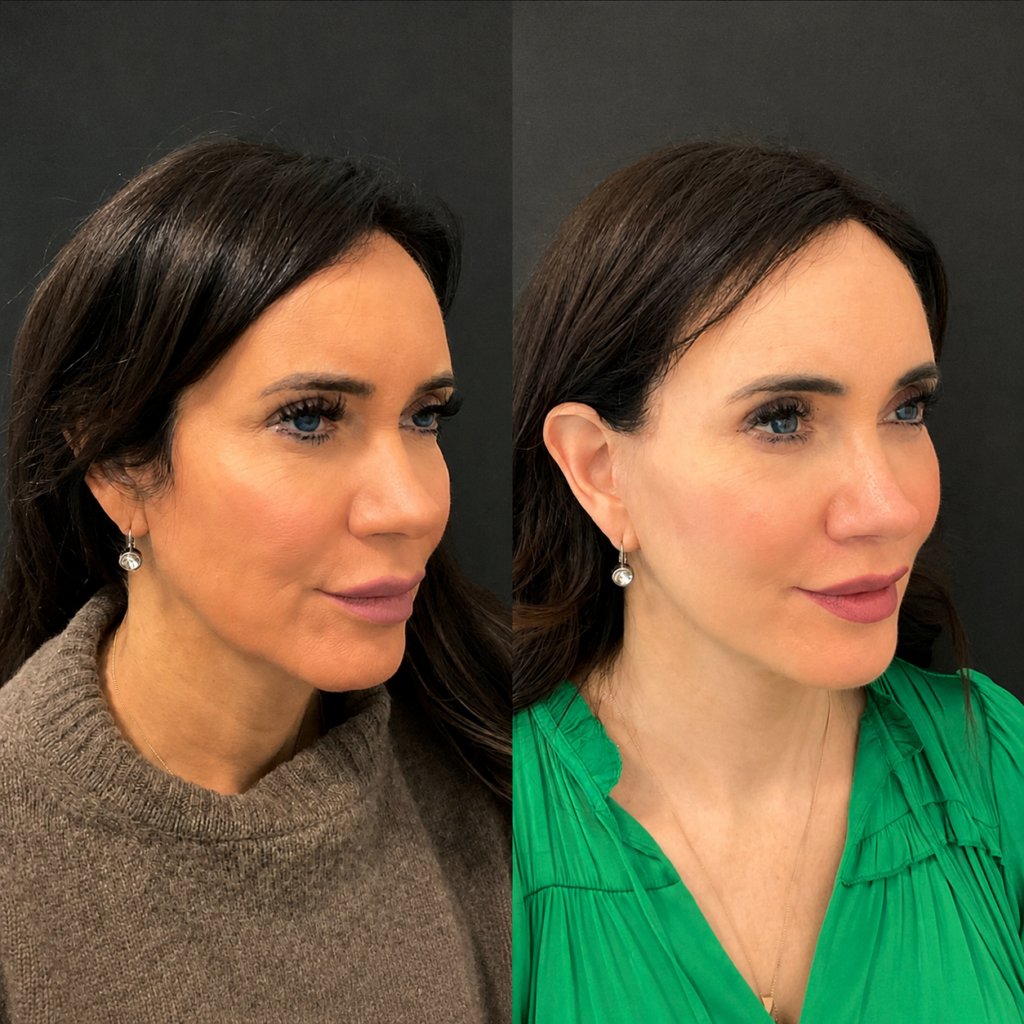 apa Deep plane face and deep neck lift, lateral brow lift, bilateral upper and lower blepharoplasty, lip lift and facial fat grafting. before and after image
