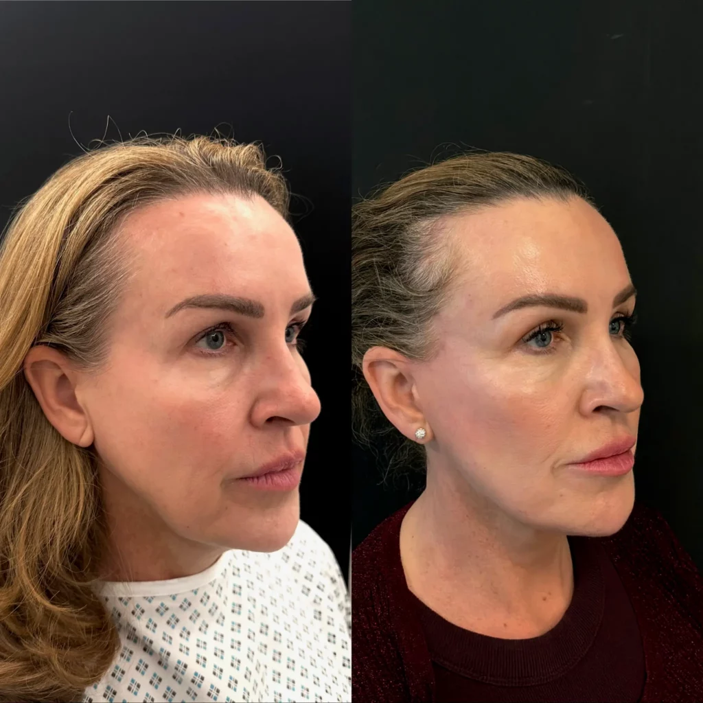 Yapa Deep plane facelift, deep necklift and lateral brow lift before and after image