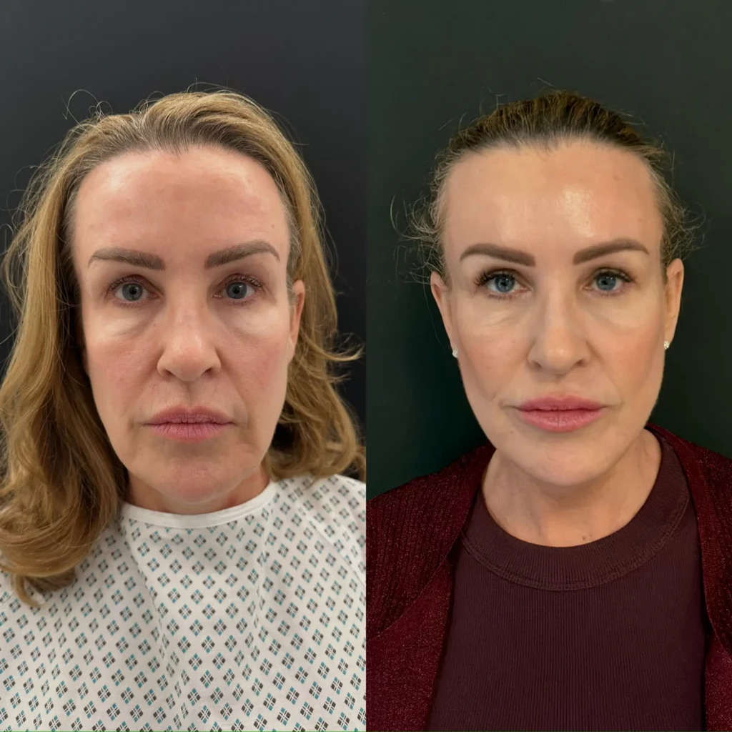 Yapa Deep plane facelift, deep necklift and lateral brow lift before and after image