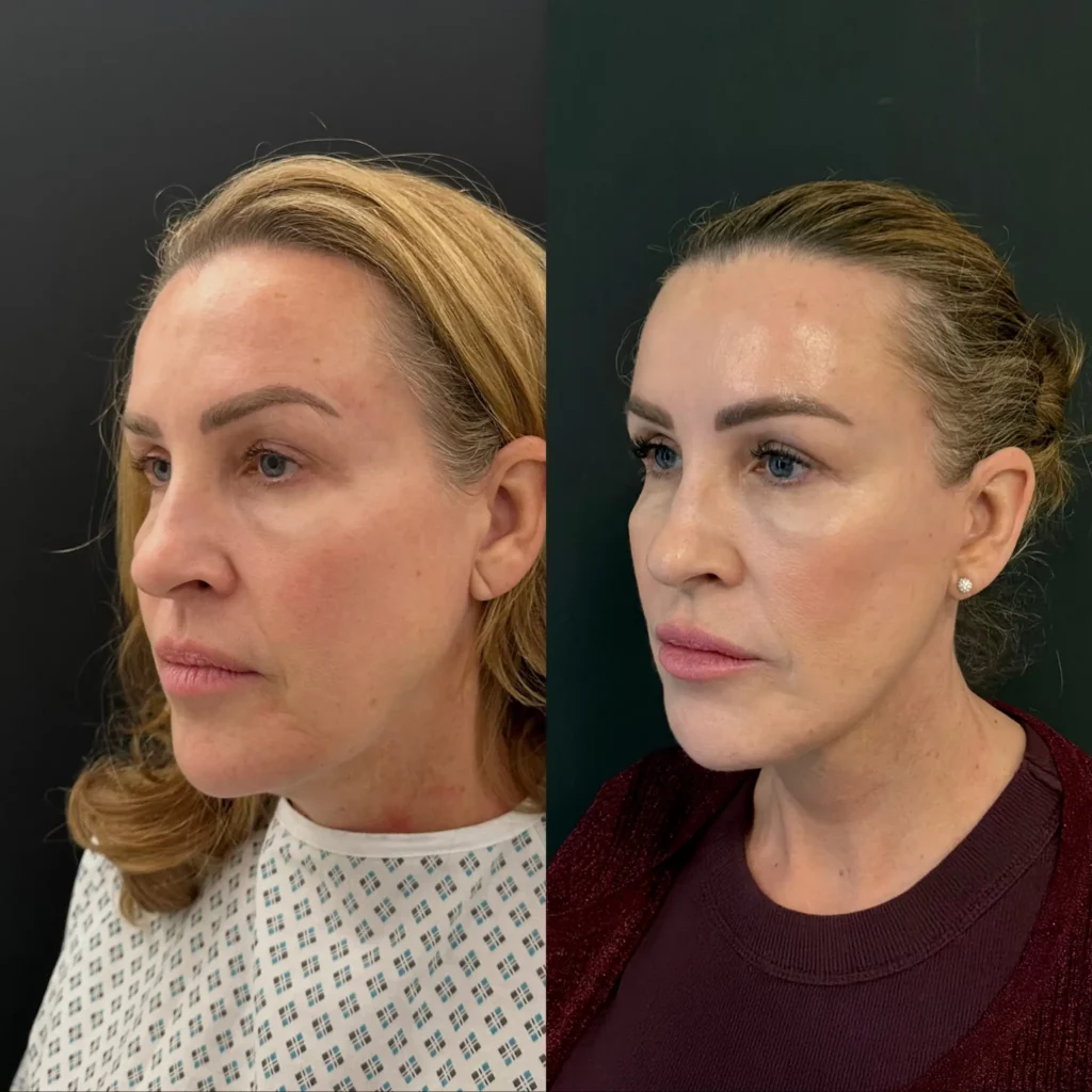 Yapa Deep plane facelift, deep necklift and lateral brow lift before and after image