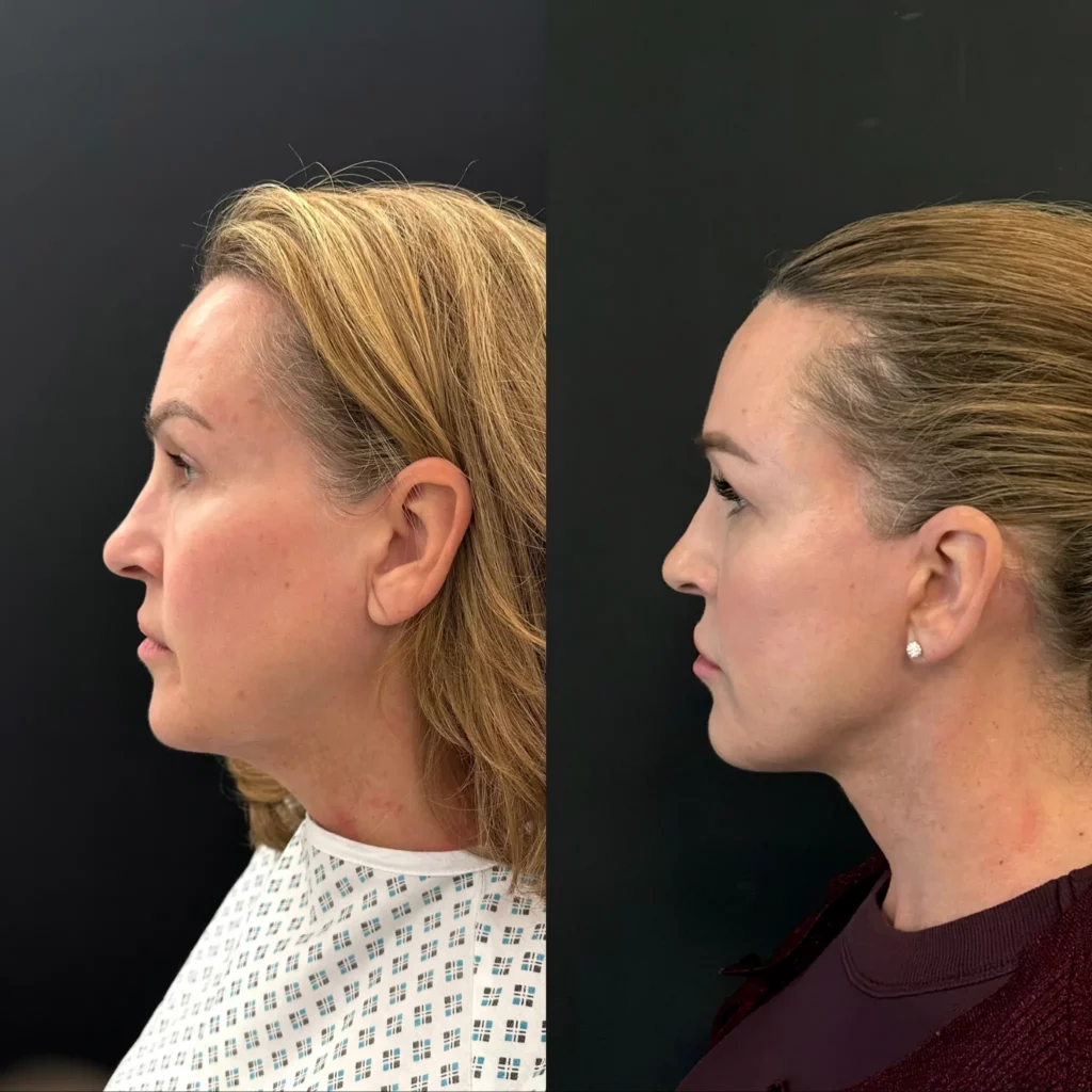 Yapa Deep plane facelift, deep necklift and lateral brow lift before and after image