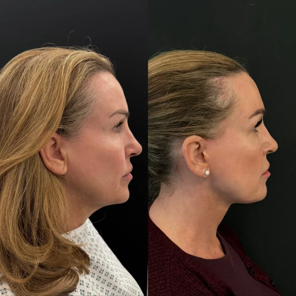 Yapa Deep plane facelift, deep necklift and lateral brow lift before and after image