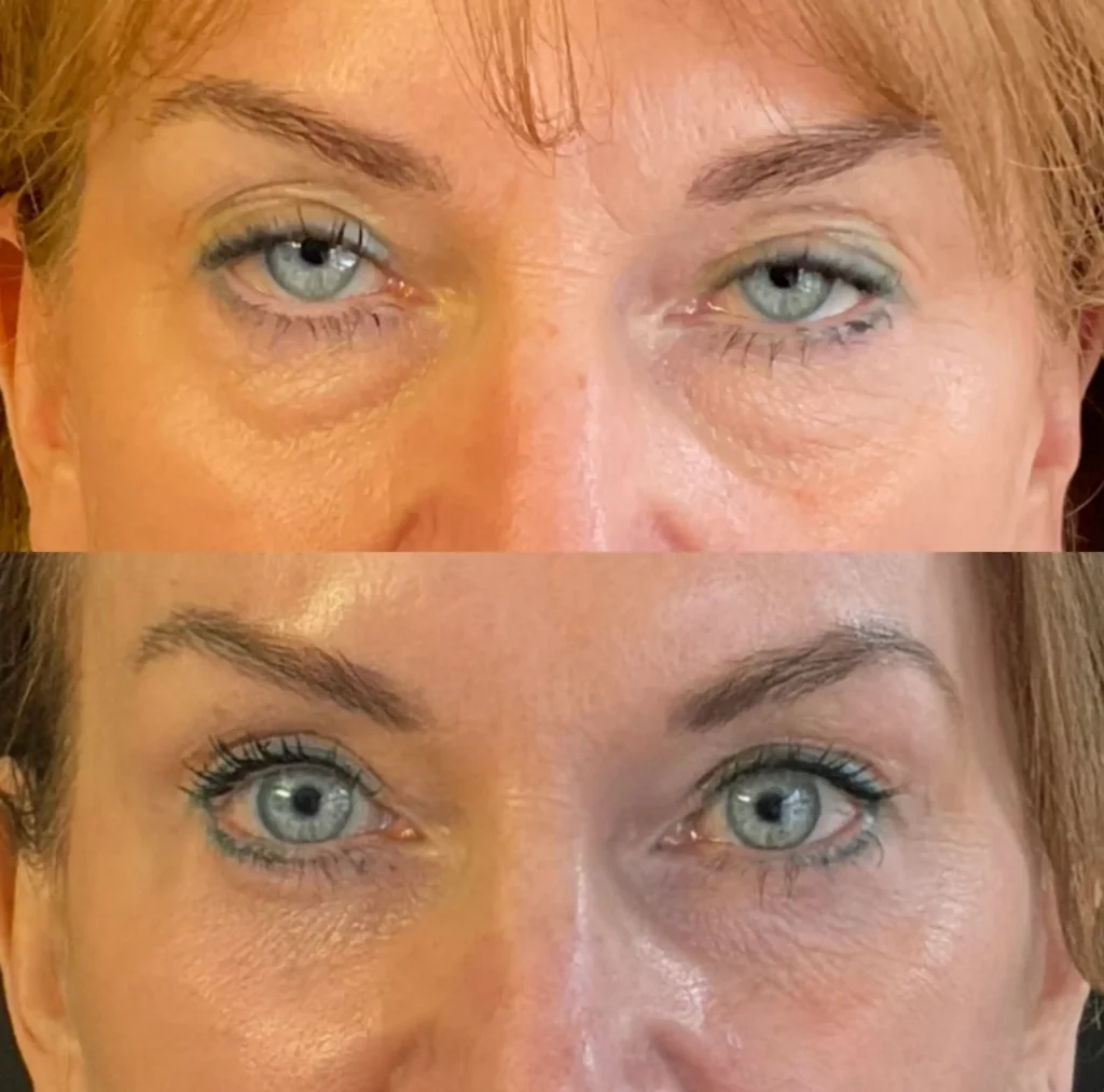 Yapa Bilateral upper and lower blepharoplatsy , lateral brow lift before and after image