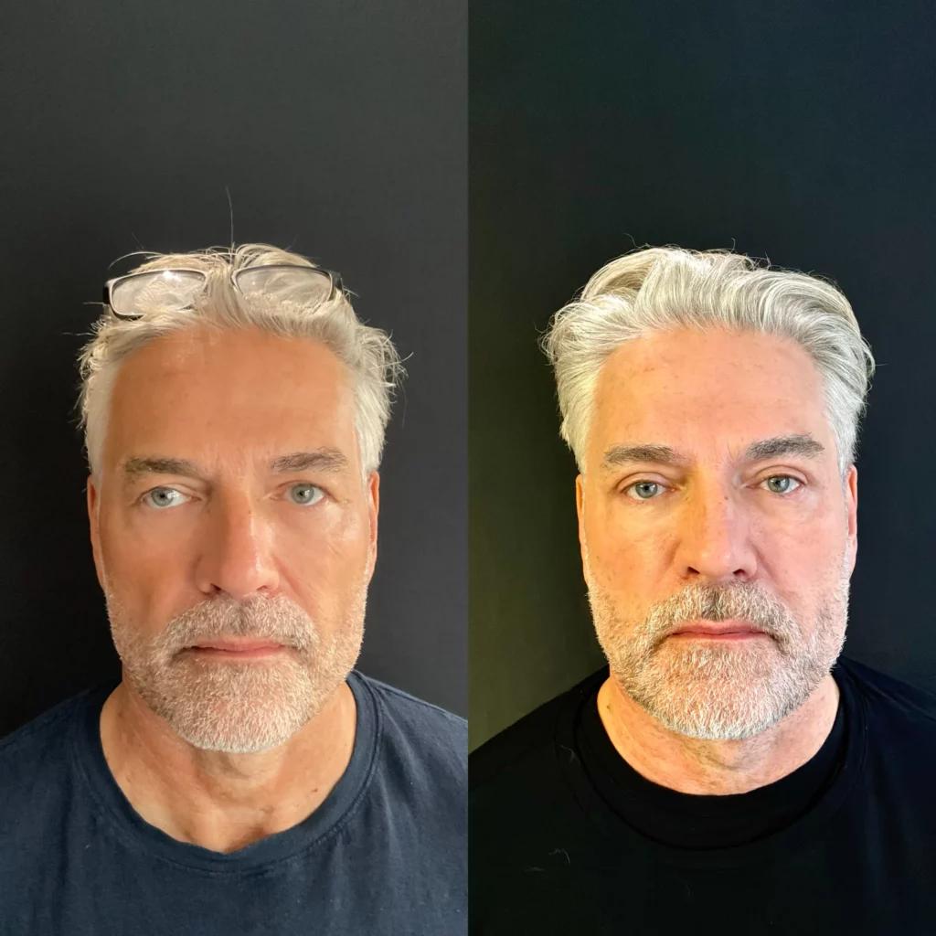 Yapa Bilateral upper blepharoplasty and endoscopic lateral and medial brow lift before and after image