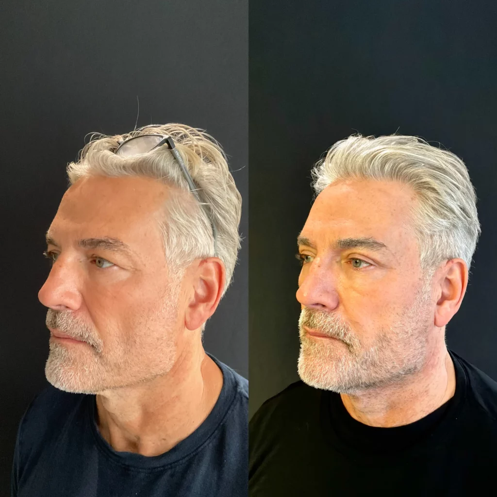 Yapa Bilateral upper blepharoplasty and endoscopic lateral and medial brow lift before and after image
