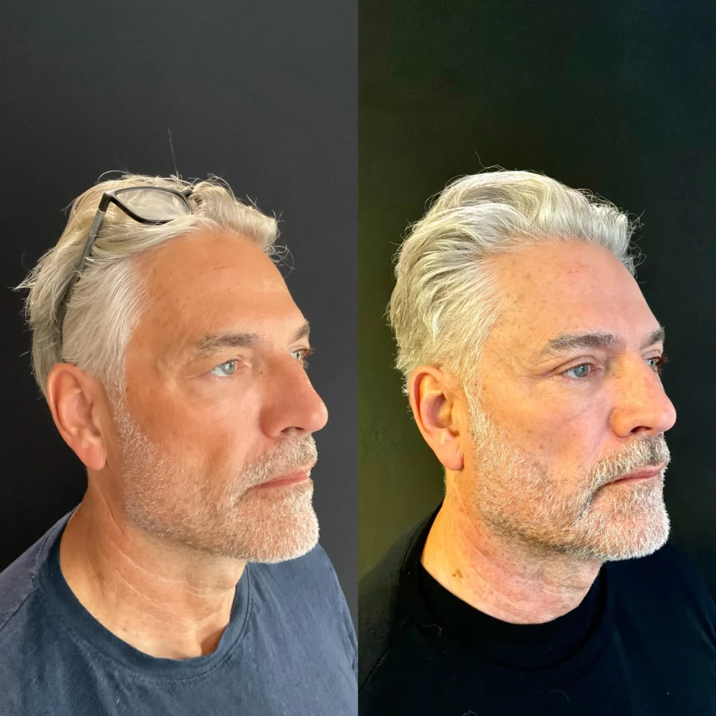 Yapa Bilateral upper blepharoplasty and endoscopic lateral and medial brow lift before and after image