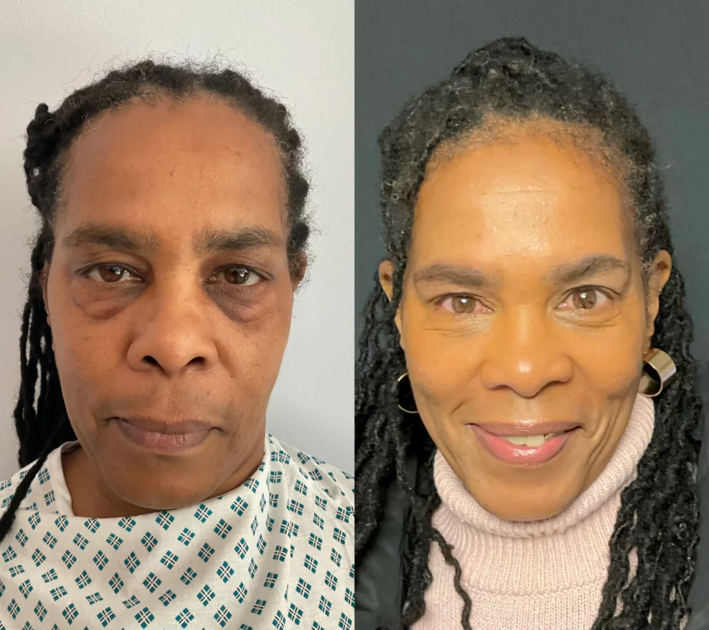 Yapa Bilateral lower blepharoplasty. before and after image