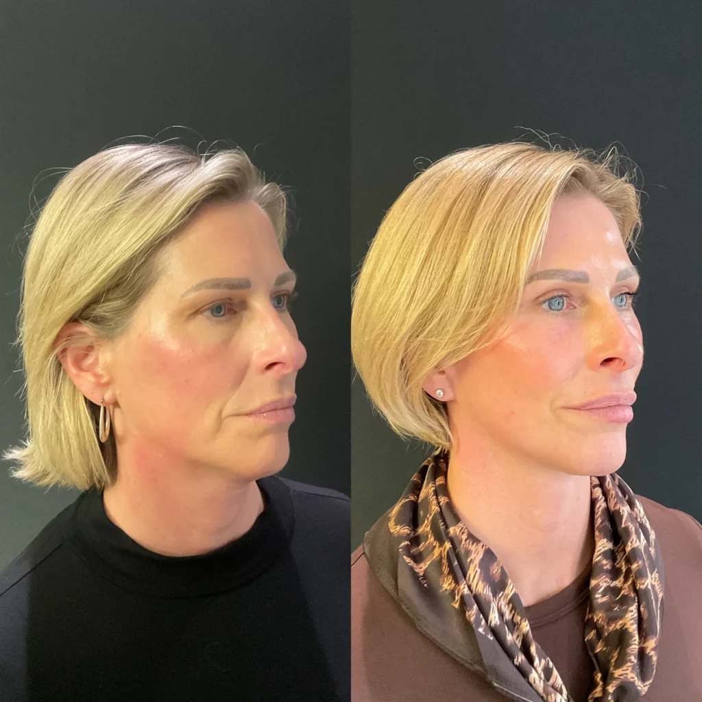 Yapa Deep plane facelift, deep neck lift, lateral brow lift, bilateral upper blepharoplasty, facial fat grafting, and full-face erbium laser resurfacing before and after image
