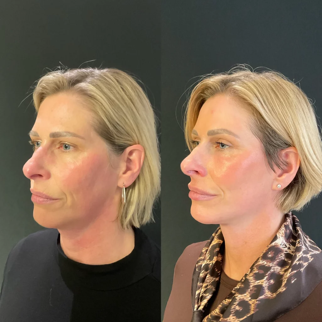 Yapa Deep plane facelift, deep neck lift, lateral brow lift, bilateral upper blepharoplasty, facial fat grafting, and full-face erbium laser resurfacing before and after image