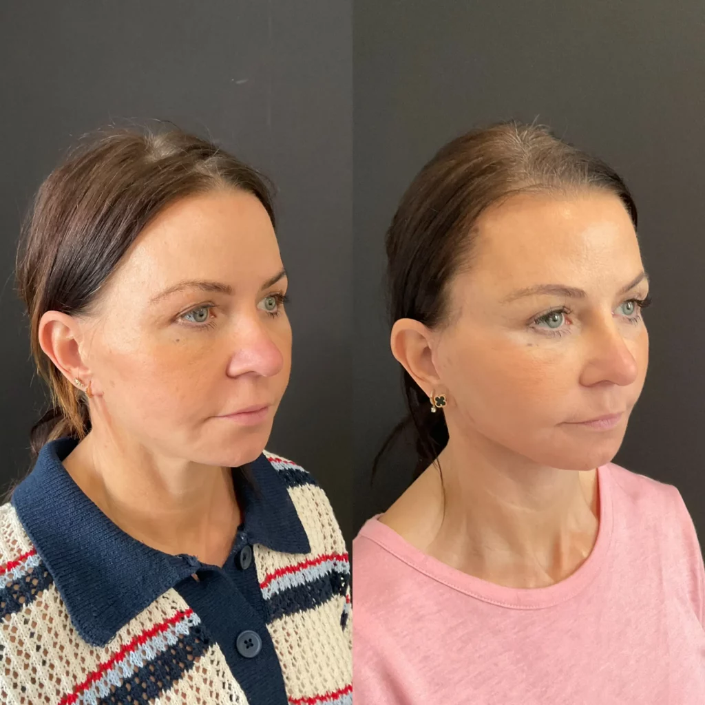 Yapa Revision deep plane facelift with a deep neck lift and a lateral brow lift before and after image
