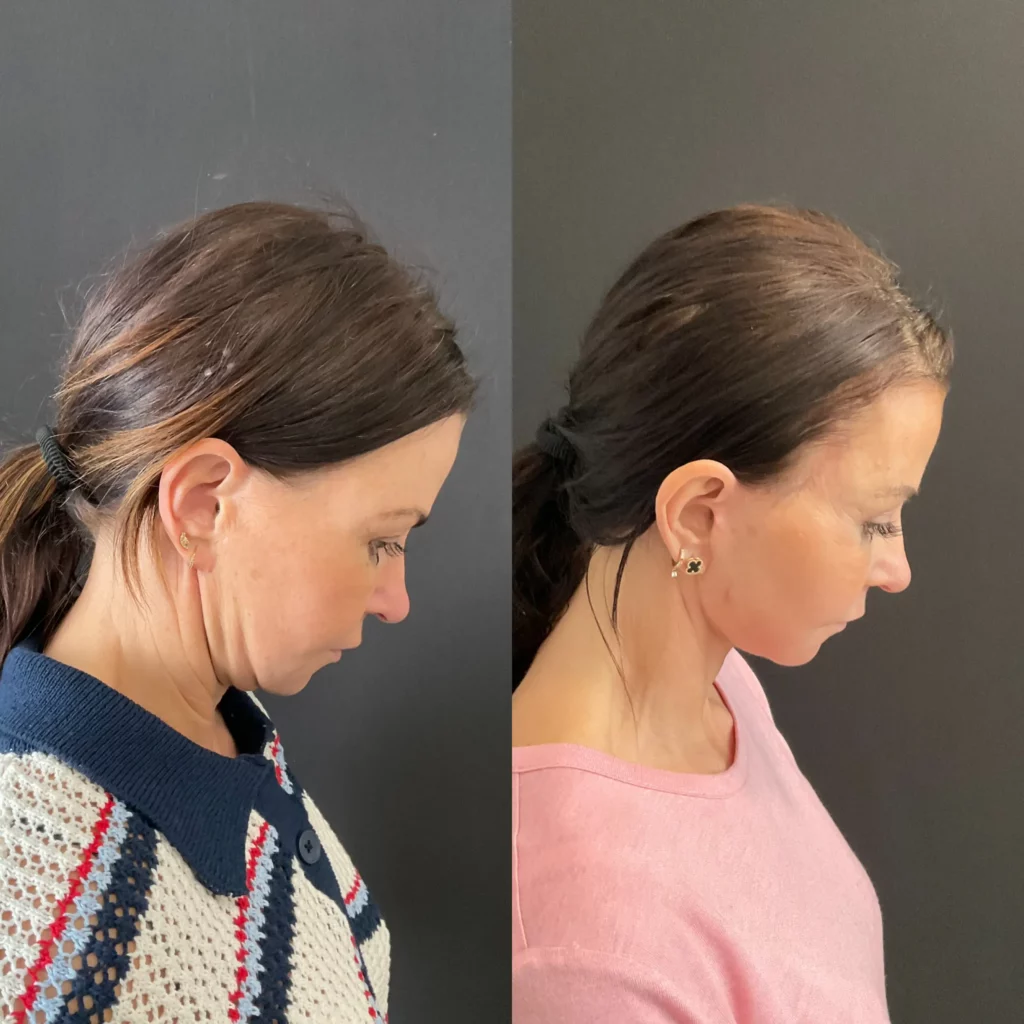 Yapa Revision deep plane facelift with a deep neck lift and a lateral brow lift before and after image