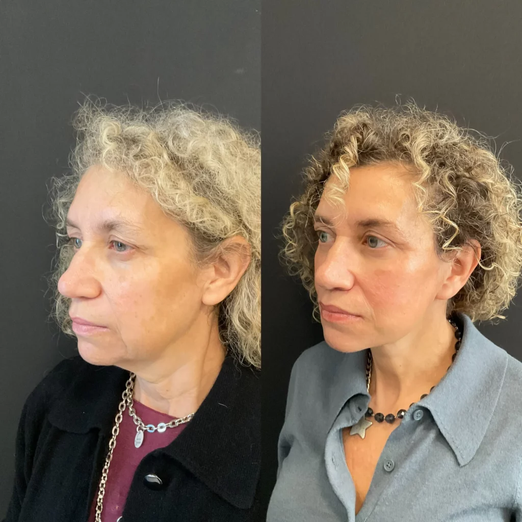 Yapa Full face rejuvination including: deep plane face and neck lift, lateral brow lift, upper blepharoplasty, facial fat grafting and upper lip lift before and after image