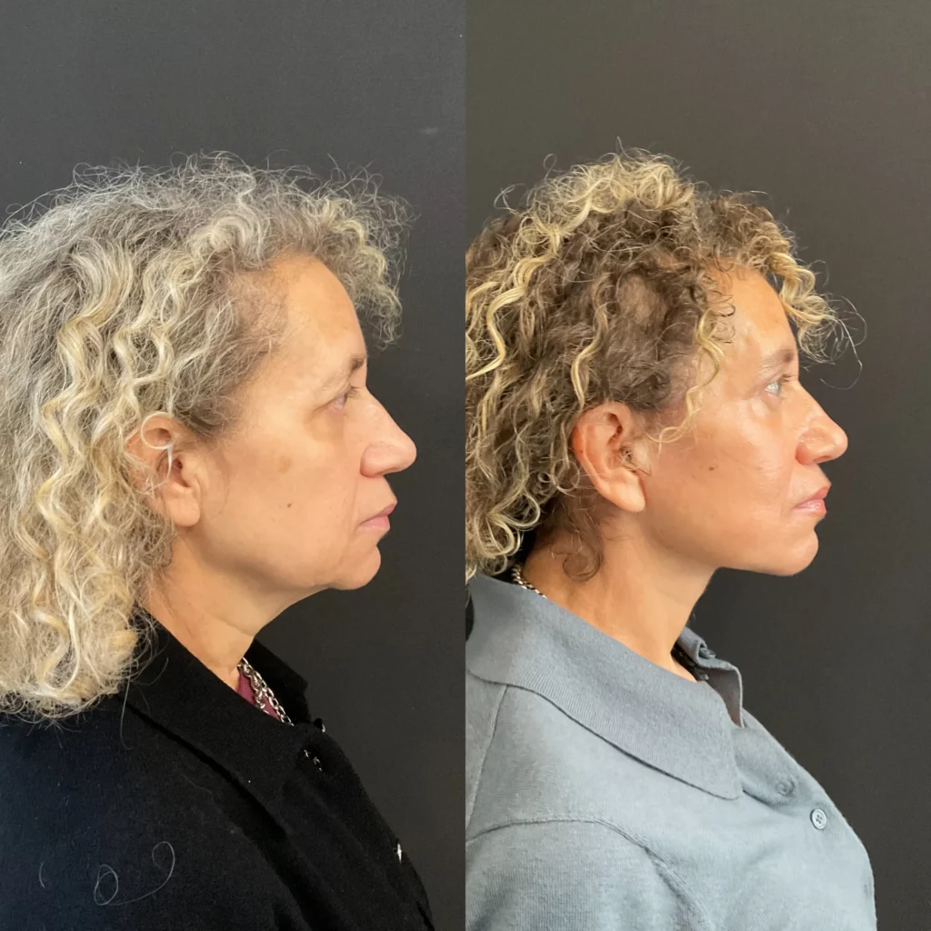 Yapa Full face rejuvination including: deep plane face and neck lift, lateral brow lift, upper blepharoplasty, facial fat grafting and upper lip lift before and after image