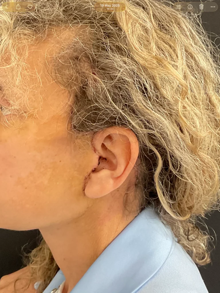Yapa Full face rejuvination including: deep plane face and neck lift, lateral brow lift, upper blepharoplasty, facial fat grafting and upper lip lift before and after image