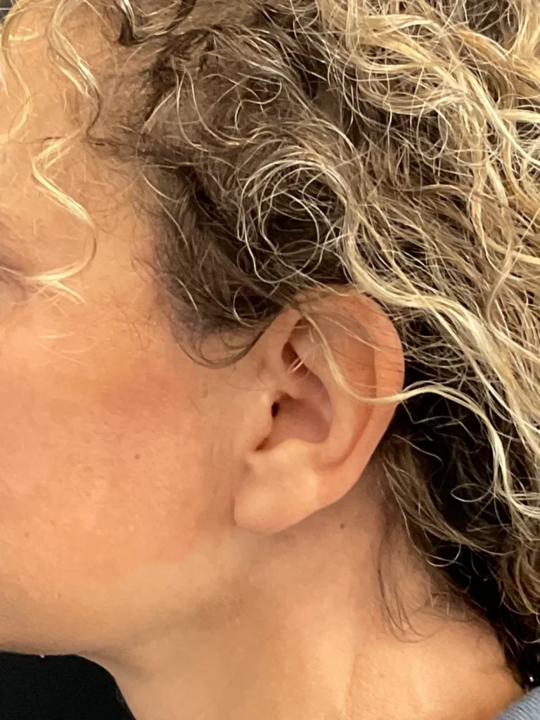 Yapa Full face rejuvination including: deep plane face and neck lift, lateral brow lift, upper blepharoplasty, facial fat grafting and upper lip lift before and after image