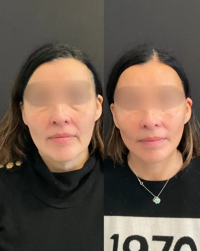 Yapa Eyes & Brows, and Face & Neck surgery before and after image