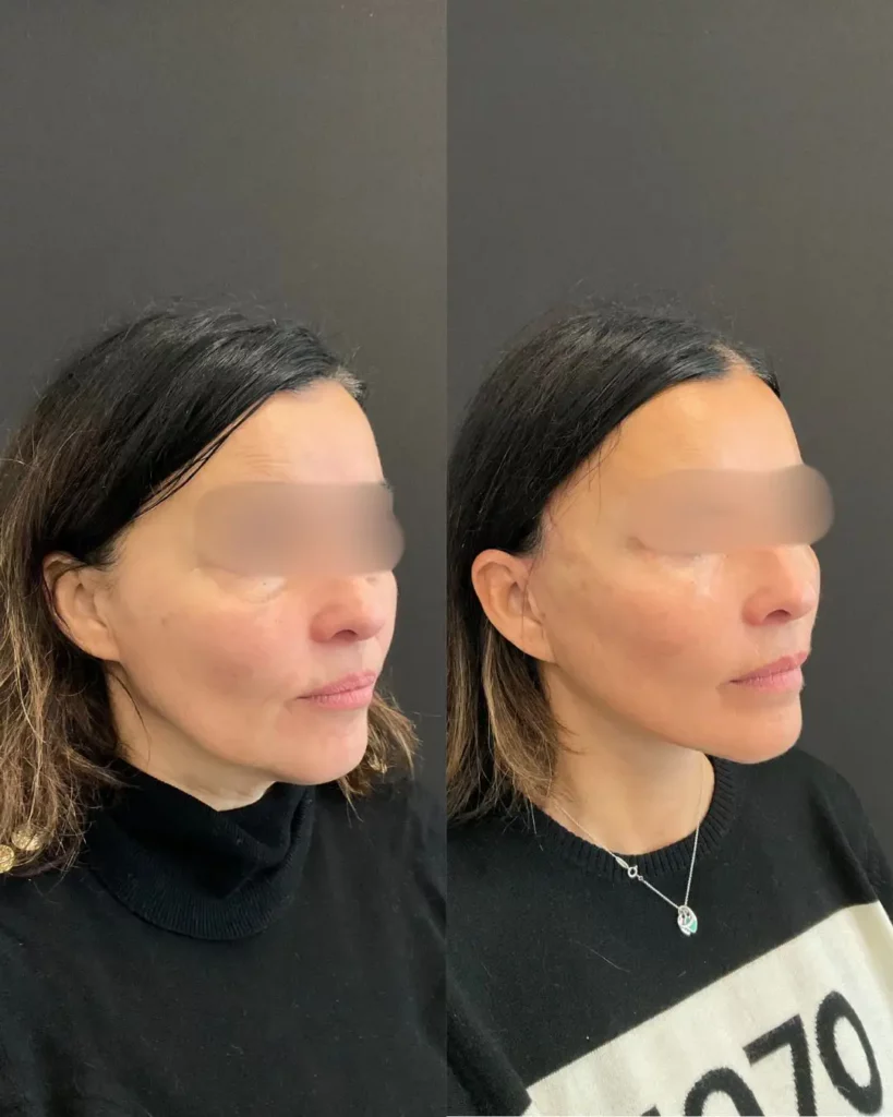 Yapa Eyes & Brows, and Face & Neck surgery before and after image