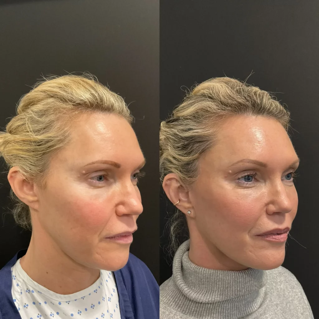 Yapa Deep plane facelift, deep plane neck lift, lateral brow lift before and after image