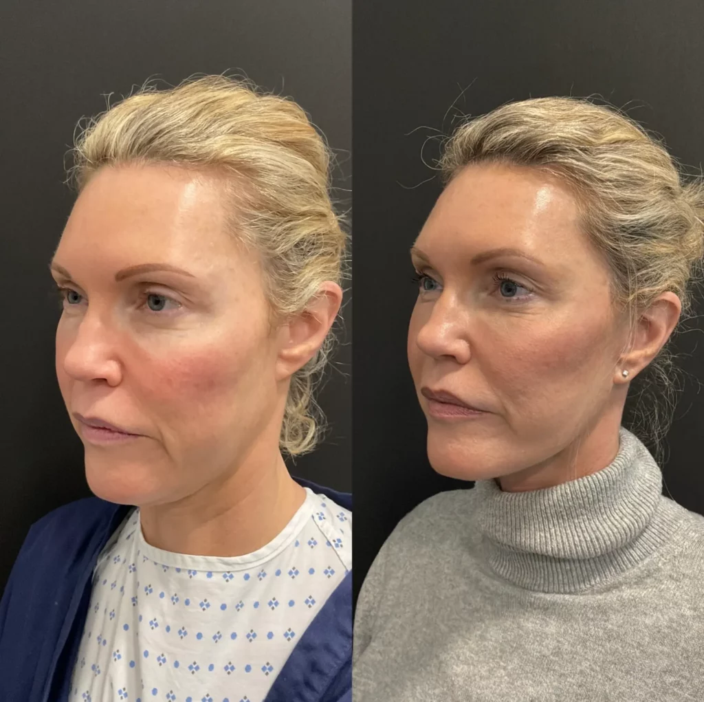 Yapa Deep plane facelift, deep plane neck lift, lateral brow lift before and after image