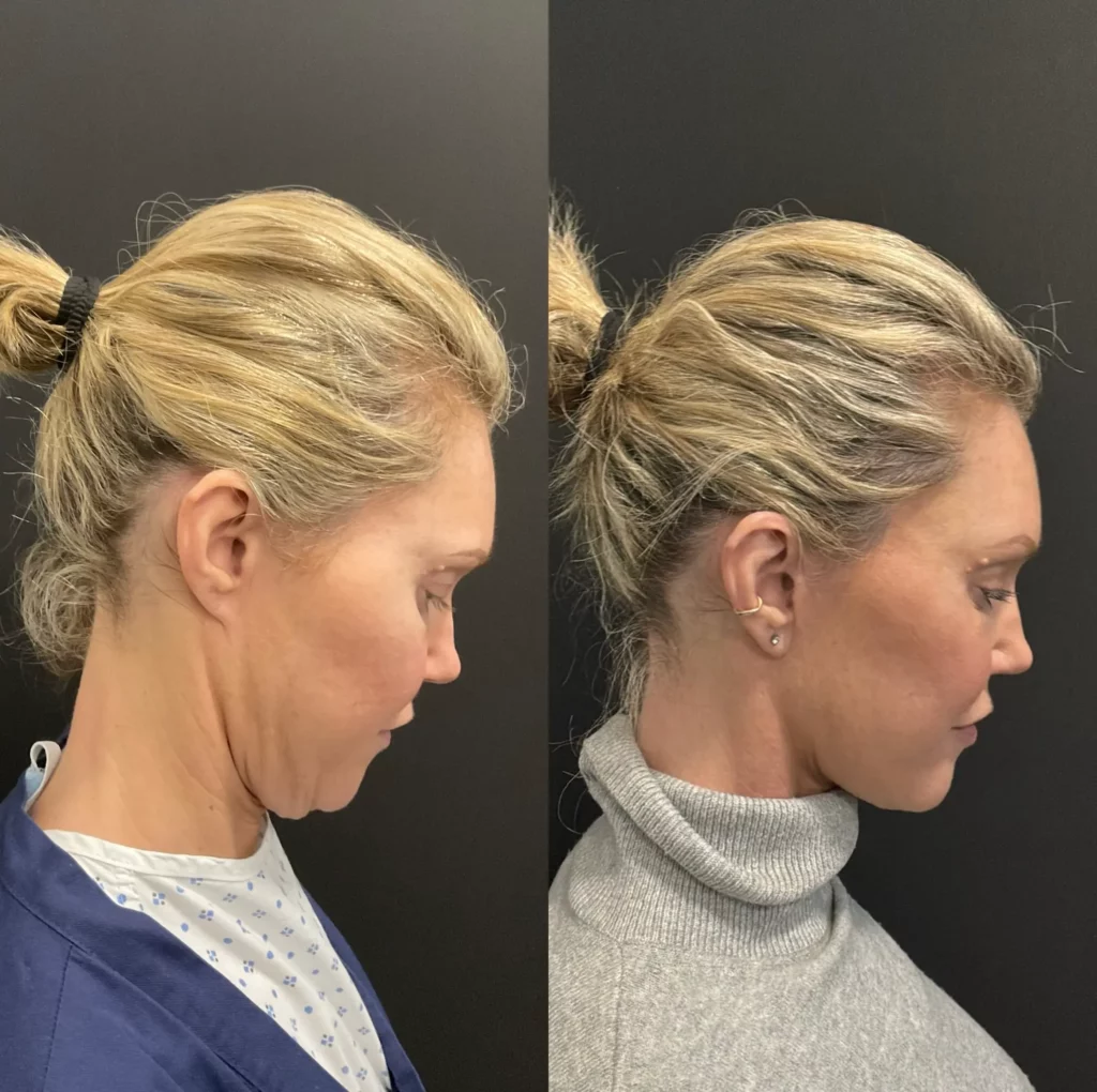 Yapa Deep plane facelift, deep plane neck lift, lateral brow lift before and after image