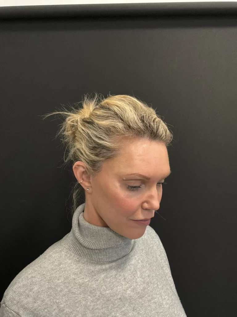 Yapa Deep plane facelift, deep plane neck lift, lateral brow lift before and after image