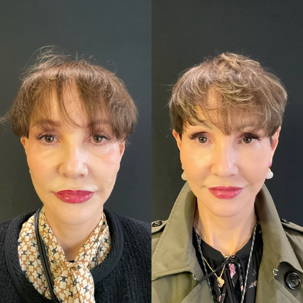 Yapa Revision deep plane facelift with a deep neck lift and a lateral brow lift, bilateral upper blepharoplatsy and facial fat transfer before and after image