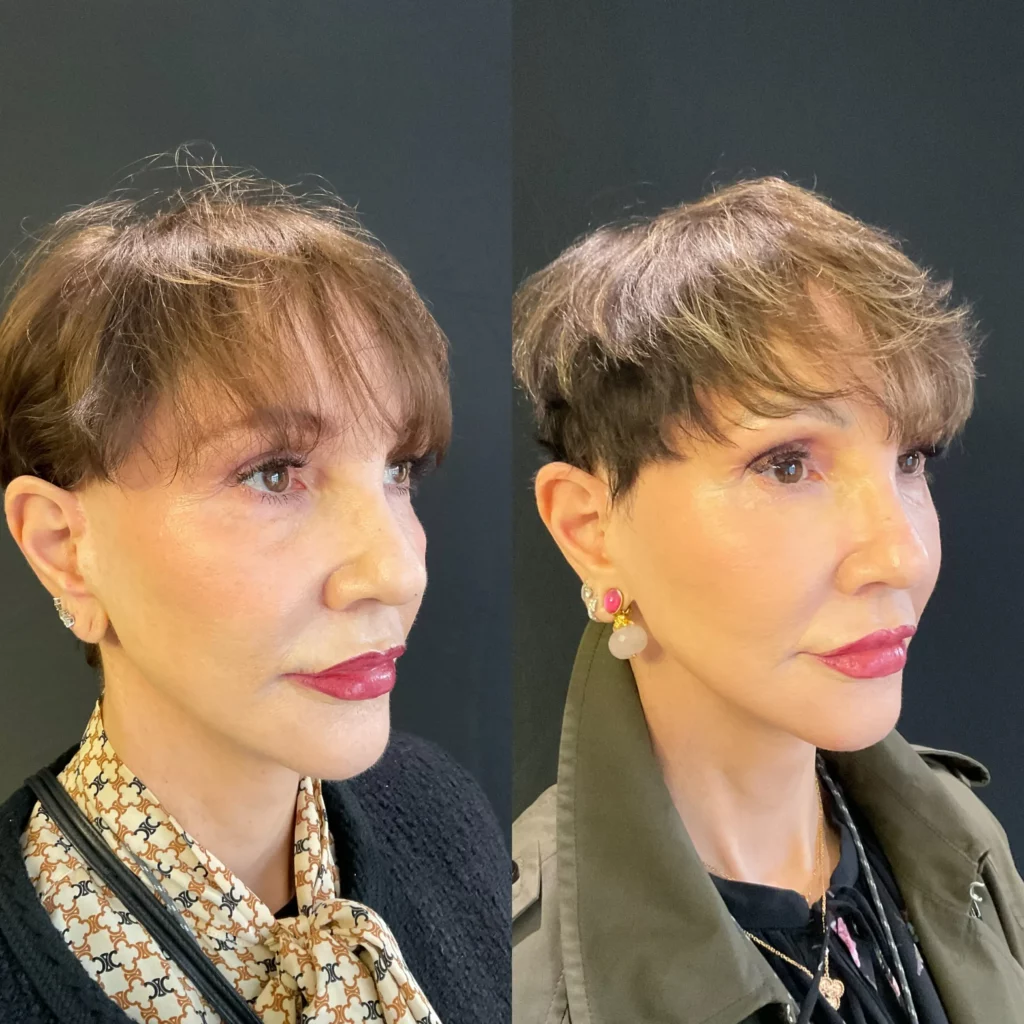 Yapa Revision deep plane facelift with a deep neck lift and a lateral brow lift, bilateral upper blepharoplatsy and facial fat transfer before and after image