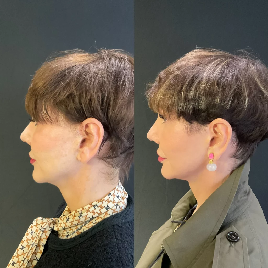 Yapa Revision deep plane facelift with a deep neck lift and a lateral brow lift, bilateral upper blepharoplatsy and facial fat transfer before and after image