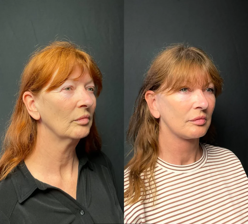 Yapa Deep plane face and deep neck lift, lateral brow lift, bilateral upper blepharoplasty, bilateral lower blepahroplasty and facial fat grafting. before and after image