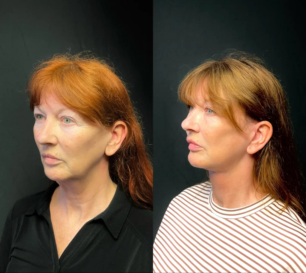 Yapa Deep plane face and deep neck lift, lateral brow lift, bilateral upper blepharoplasty, bilateral lower blepahroplasty and facial fat grafting. before and after image