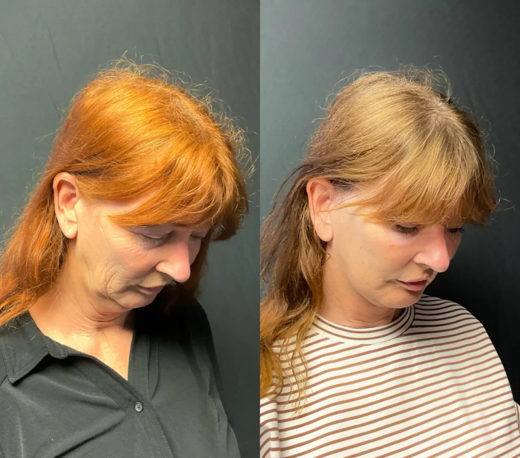 Yapa Deep plane face and deep neck lift, lateral brow lift, bilateral upper blepharoplasty, bilateral lower blepahroplasty and facial fat grafting. before and after image