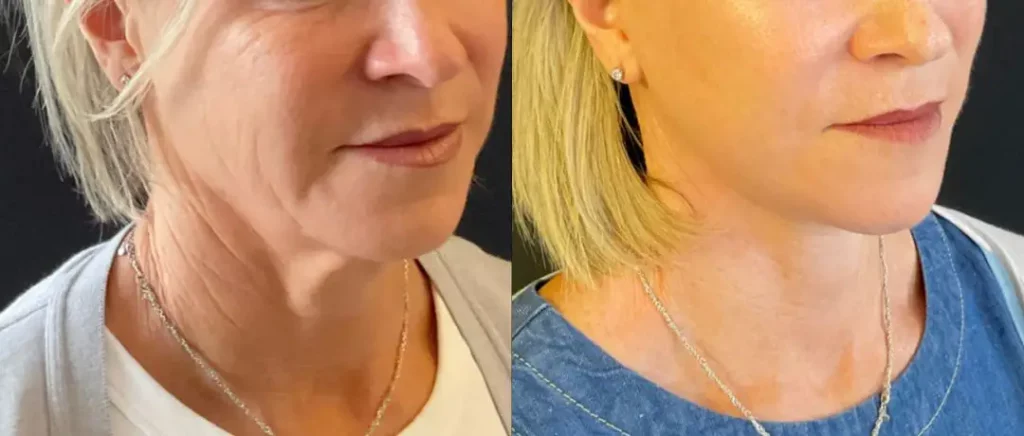 Yapa Eyes & Brows, and Face & Neck surgery before and after image