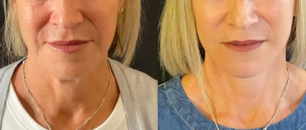 Yapa Eyes & Brows, and Face & Neck surgery before and after image