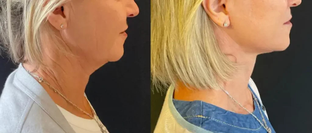 Yapa Eyes & Brows, and Face & Neck surgery before and after image