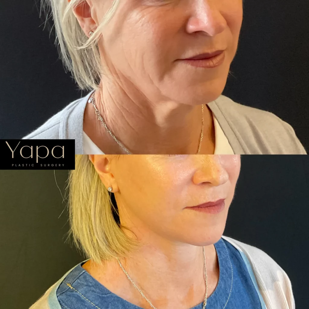 Yapa Deep Plane face and neck lift. lateral brow lift, bilateral upper and lower blepharoplasty. Subtle Facial Fat Grafting (temples, under eyes, mid-face) before and after image