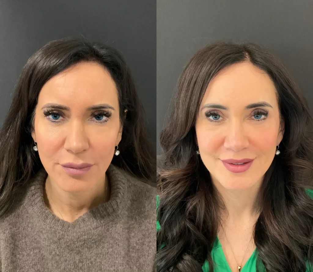 Yapa Deep plane face and deep neck lift, lateral brow lift, bilateral upper and lower blepharoplasty, lip lift and facial fat grafting. before and after image