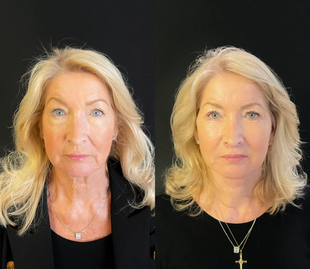 Yapa Deep plane face lift and deep neck neck lift, lateral brow lift, facial fat grafting, bilateral upper and lower blepharoplatsy and upper lip lift. before and after image