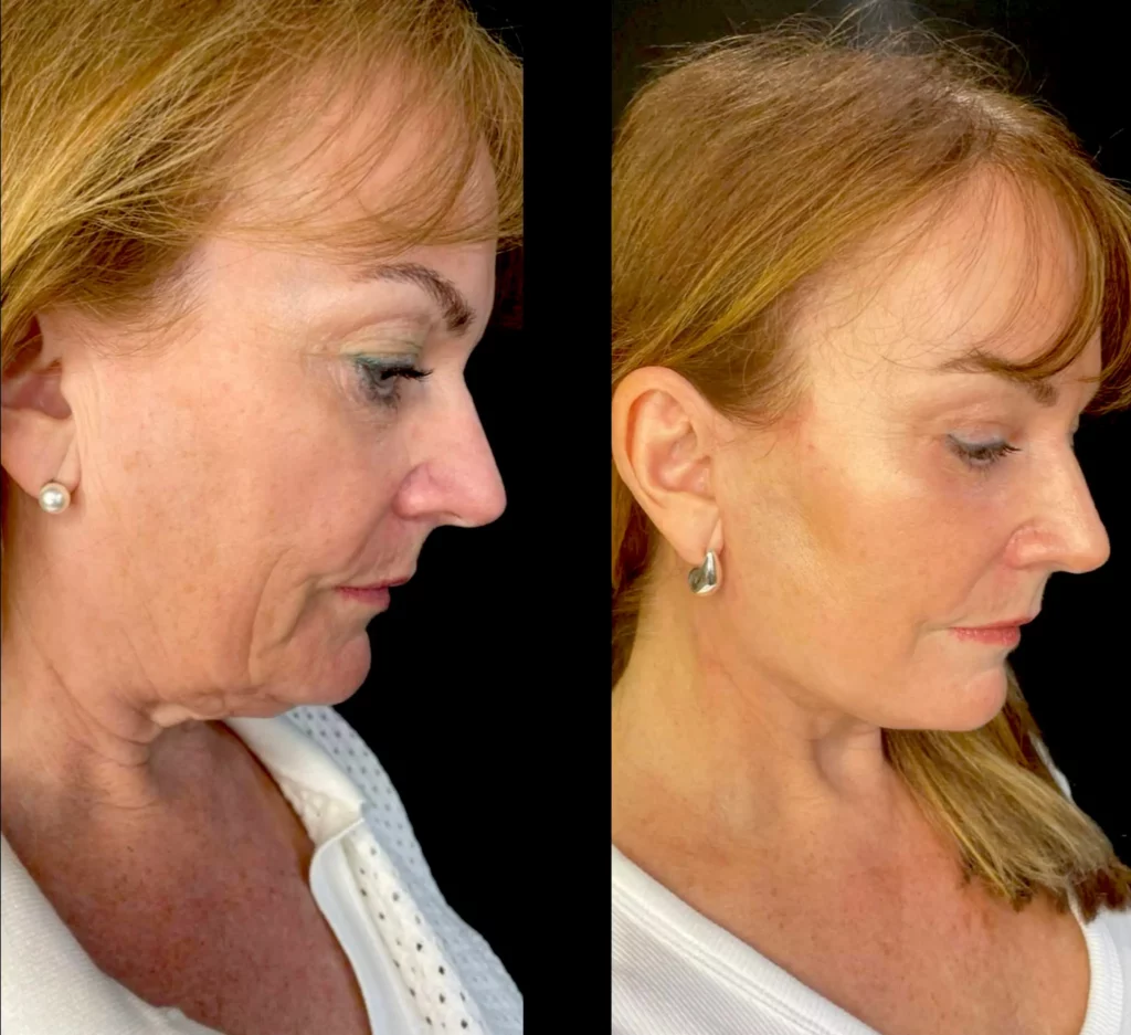 Yapa A deep plane face lift and deep neck lift , lateral brow lift, bilateral upper and lower blepharoplasty plus facial fat transfer. before and after image