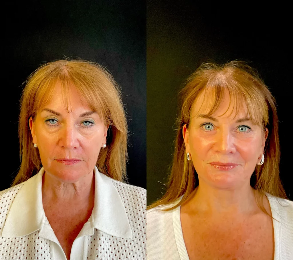 Yapa A deep plane face lift and deep neck lift , lateral brow lift, bilateral upper and lower blepharoplasty plus facial fat transfer. before and after image