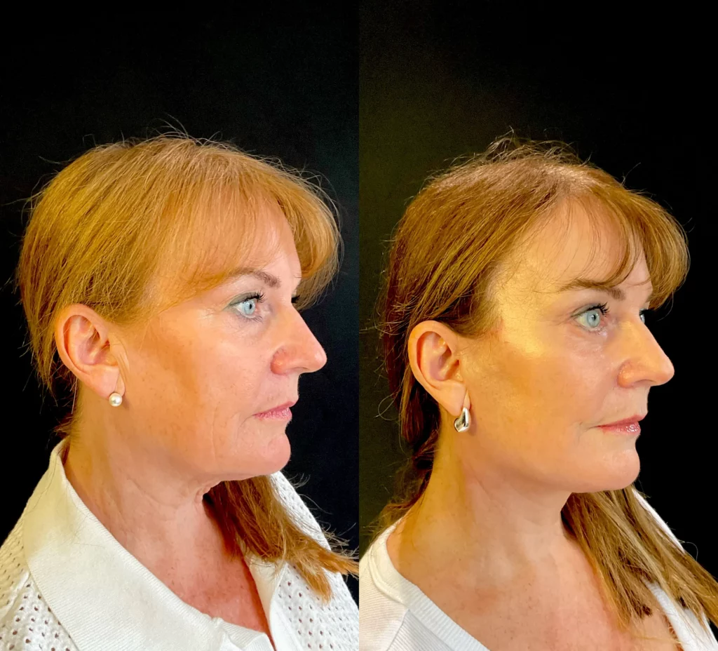 Yapa A deep plane face lift and deep neck lift , lateral brow lift, bilateral upper and lower blepharoplasty plus facial fat transfer. before and after image