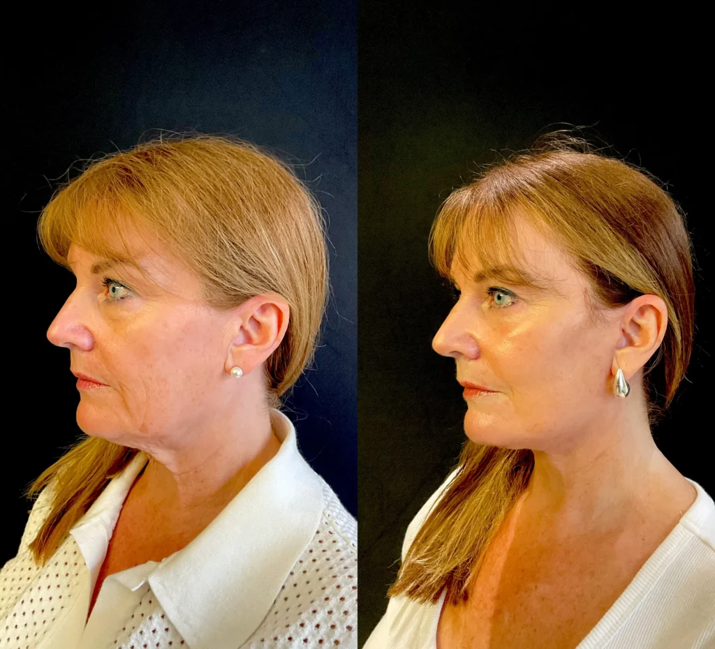 Yapa A deep plane face lift and deep neck lift , lateral brow lift, bilateral upper and lower blepharoplasty plus facial fat transfer. before and after image