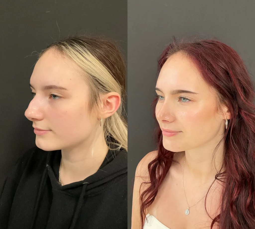 Yapa Open septorhinoplasty. Piezo ultrasonic rhinoplasty before and after image