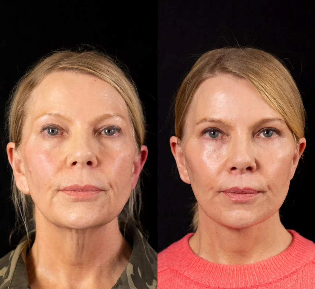 Yapa Deep plane facelift , deep neck lift , bilateral upper and lower blepharoplasty, lateral brow lift , lip lift , ear lobe reduction , facial fat grafting before and after image
