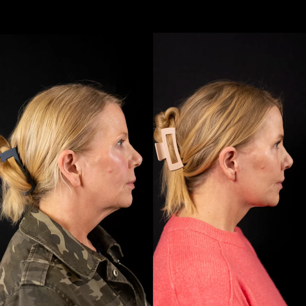 Yapa Deep plane facelift , deep neck lift , bilateral upper and lower blepharoplasty, lateral brow lift , lip lift , ear lobe reduction , facial fat grafting before and after image