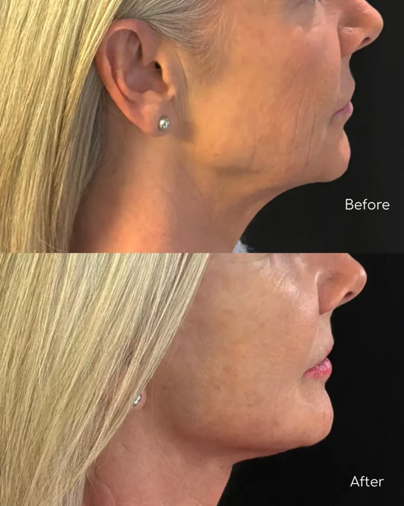 Yapa Eyes & Brows, and Face & Neck surgery before and after image