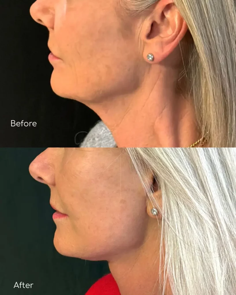 Yapa Eyes & Brows, and Face & Neck surgery before and after image
