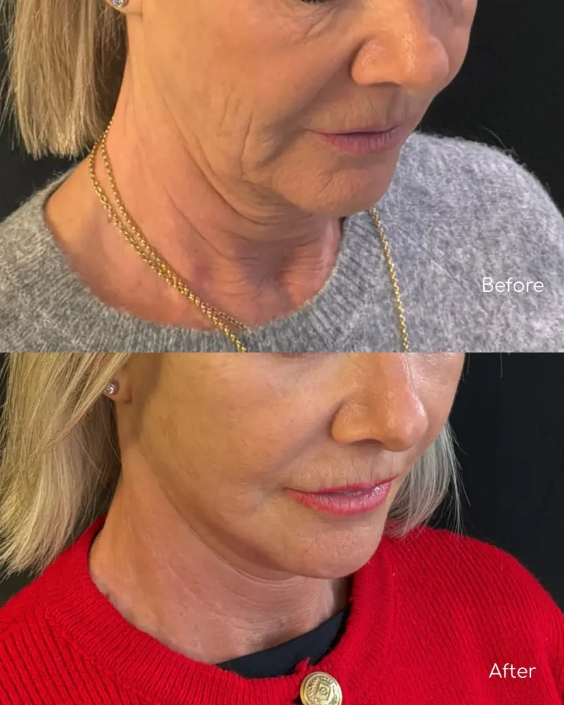 Yapa Eyes & Brows, and Face & Neck surgery before and after image